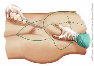 Liposuktion am Bauch: Der Chirurg führt mit einer Hand die Kanüle zur Fettabsaugung und tastet mit der anderen Hand die Dicke des Fettgewebes.